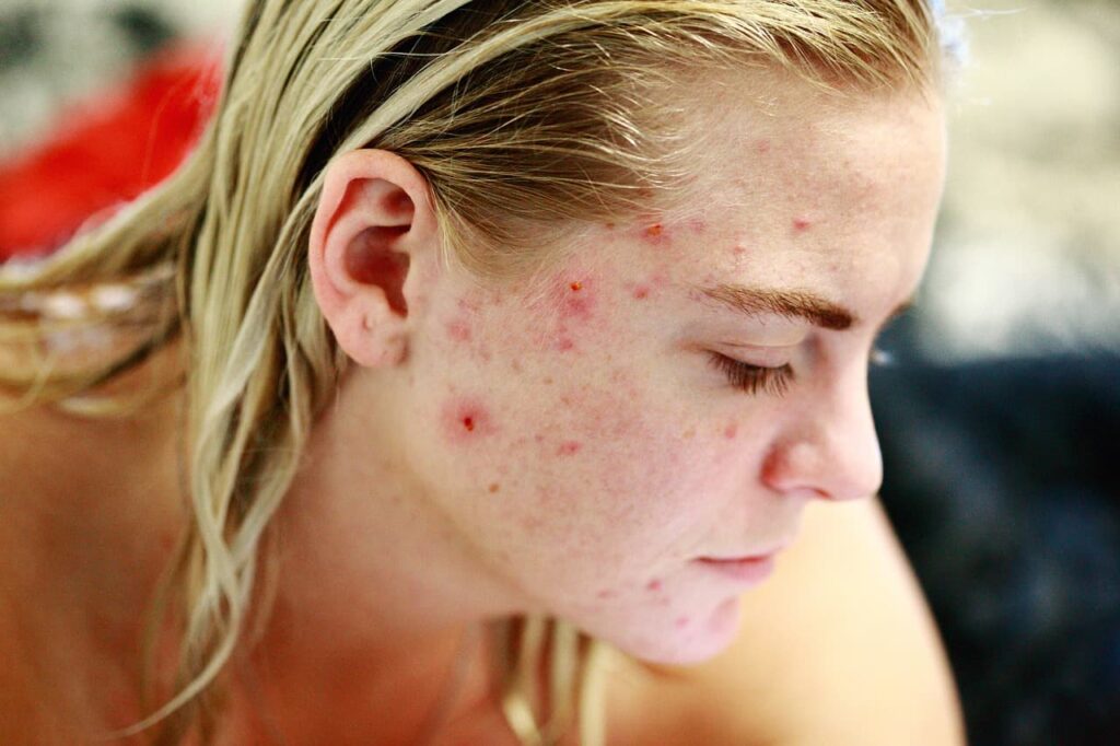 can collagen cause acne